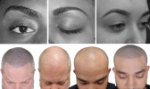 Eyebrow shape perfection above & Scalp Micropigmentation below